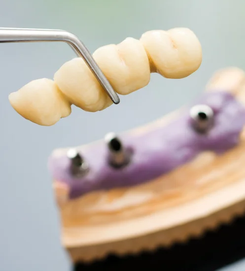 Benefits of Dental Bridge Treatment