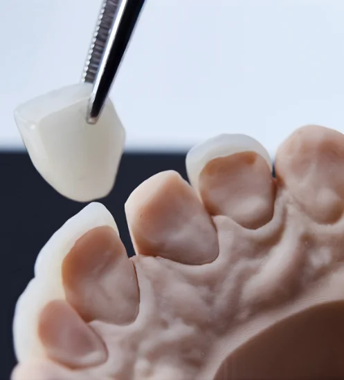 Caring for Your Dental Crown