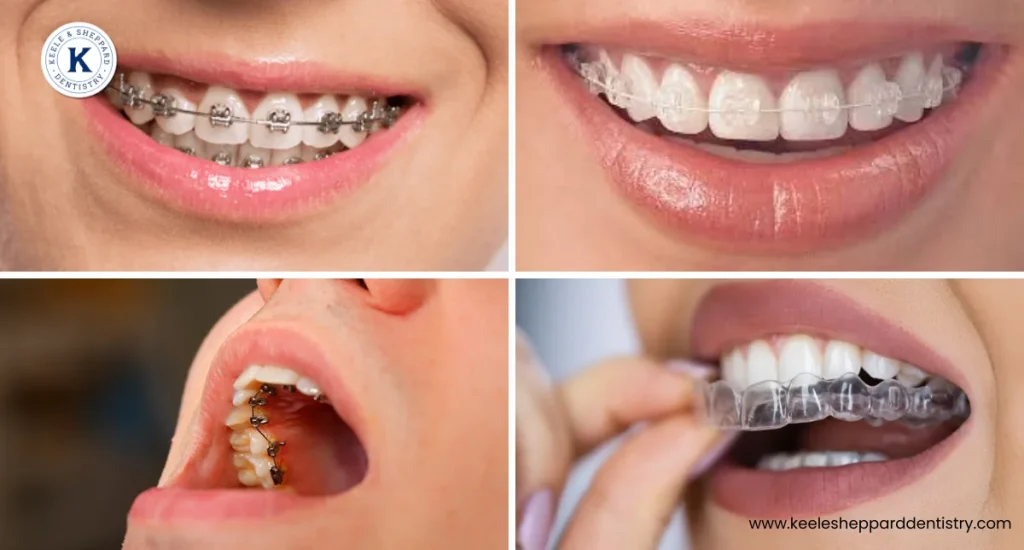 4 Types of Braces 