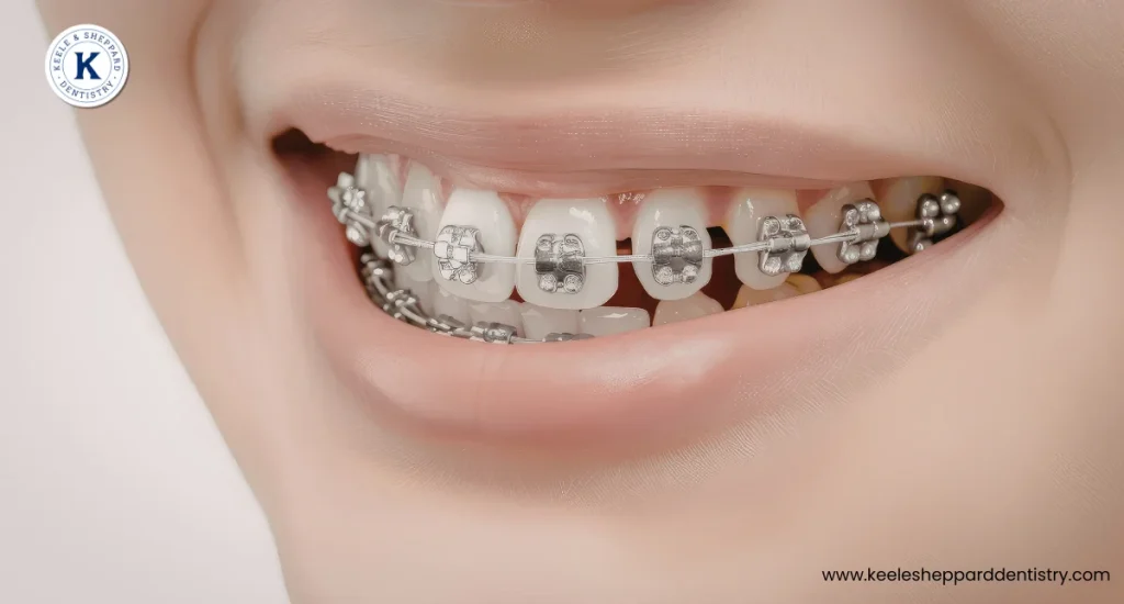 What Are Metal Braces