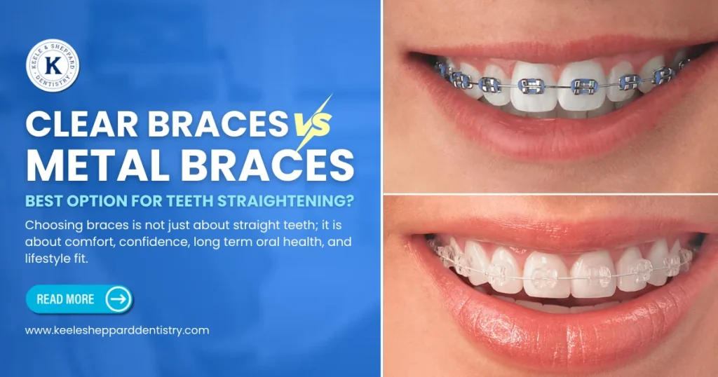 clear vs metal braces