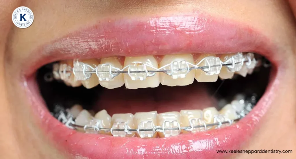 Ceramic Braces