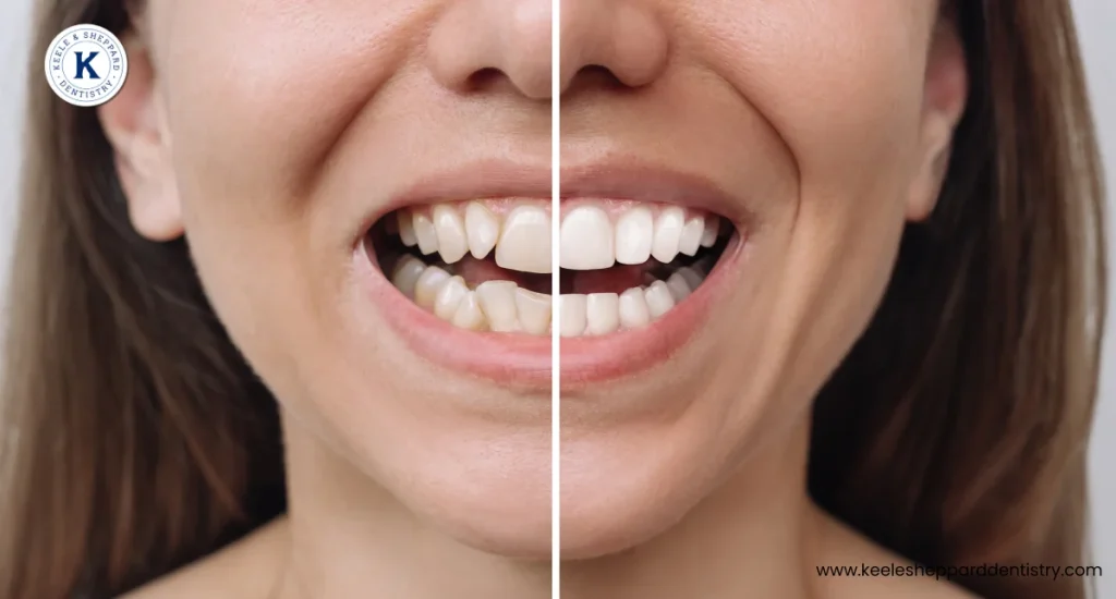 Cosmetic Bonding and Veneers