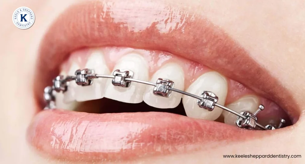 Self-Ligating Braces